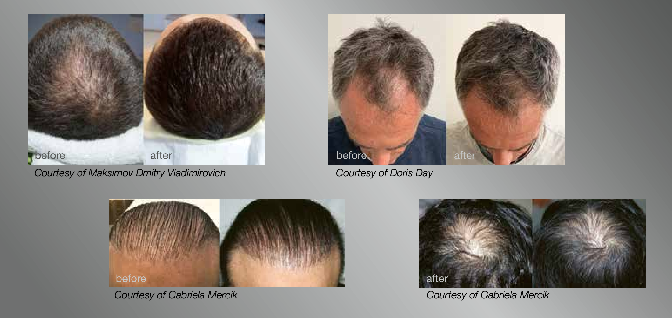antes e depois tratamento a laser para queda de cabelo fotona