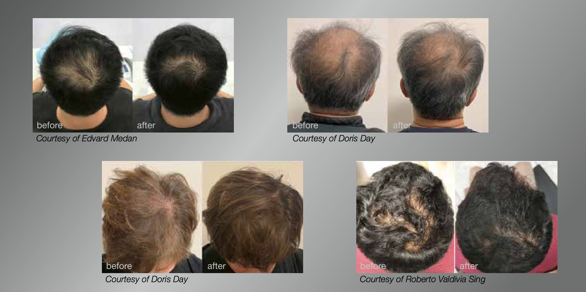 antes e depois tratamento a laser para queda de cabelo