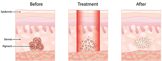 pigmented lesions laser removal